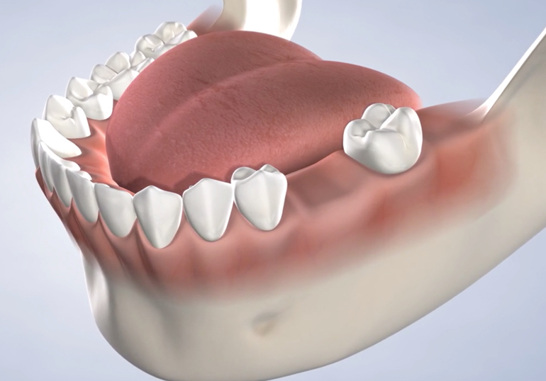 Dental bridge missing tooth gap
