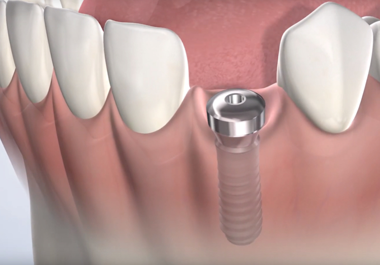 Dental implants in North Las Vegas, NV